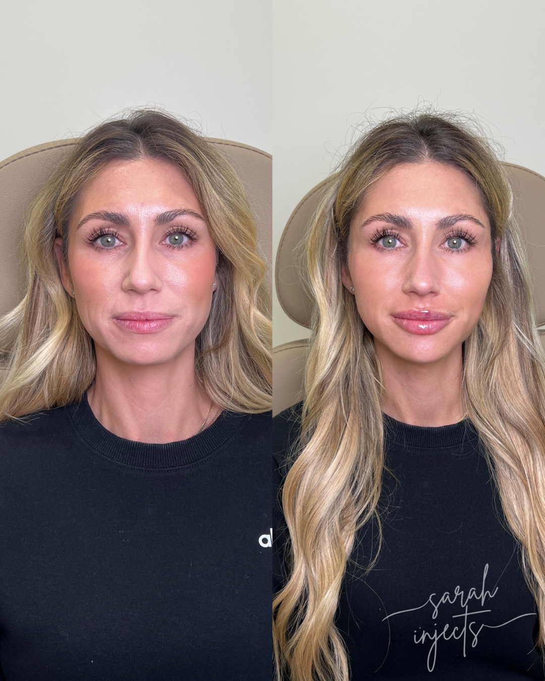 Facial Balancing Before & After