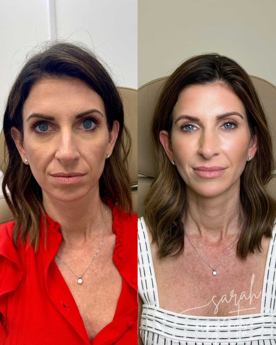 Facial Balancing Before & After 2