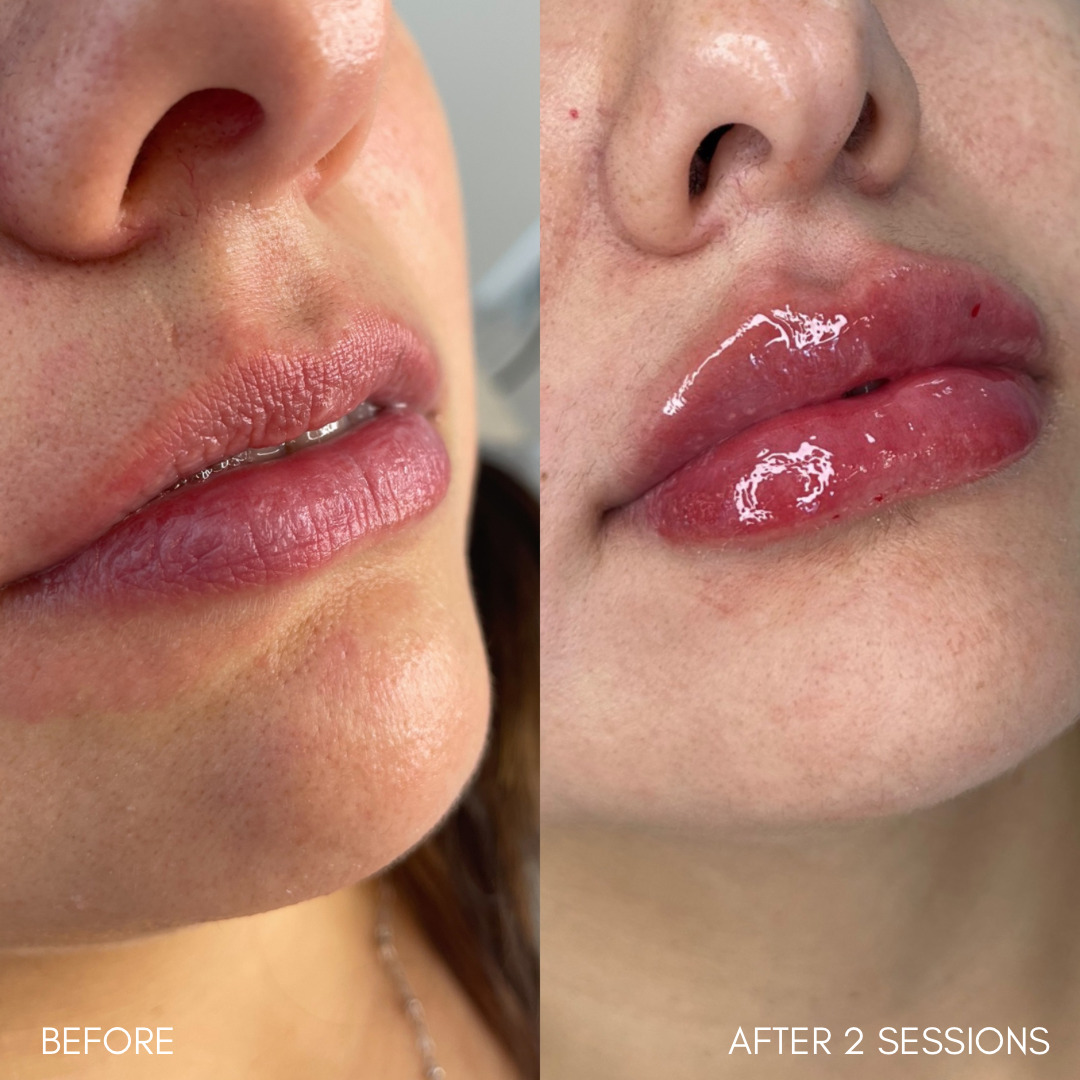 Lily Lip Before & After