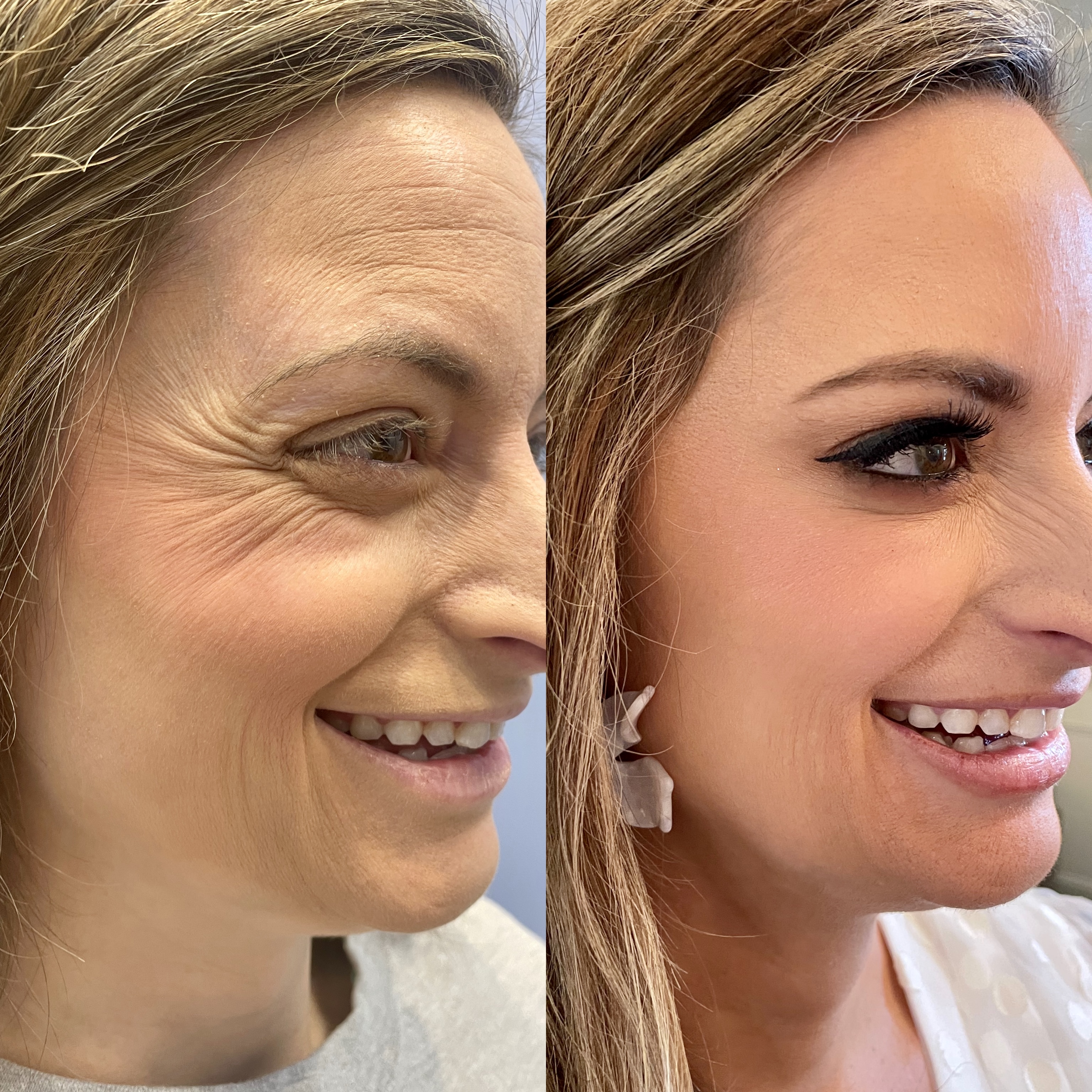 Neurotoxin Before & After 2