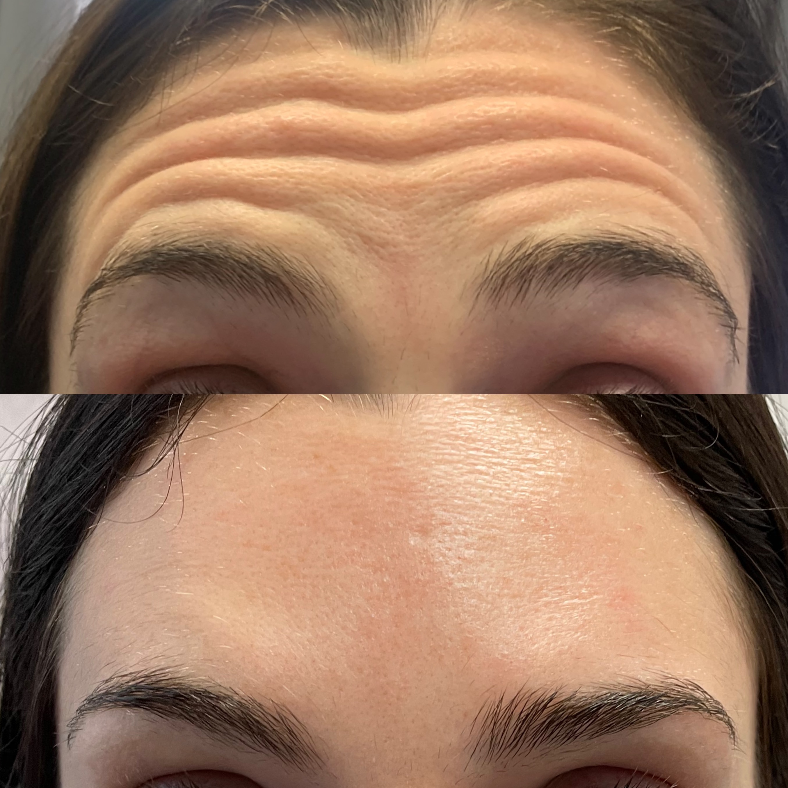 Botox Before & After 2